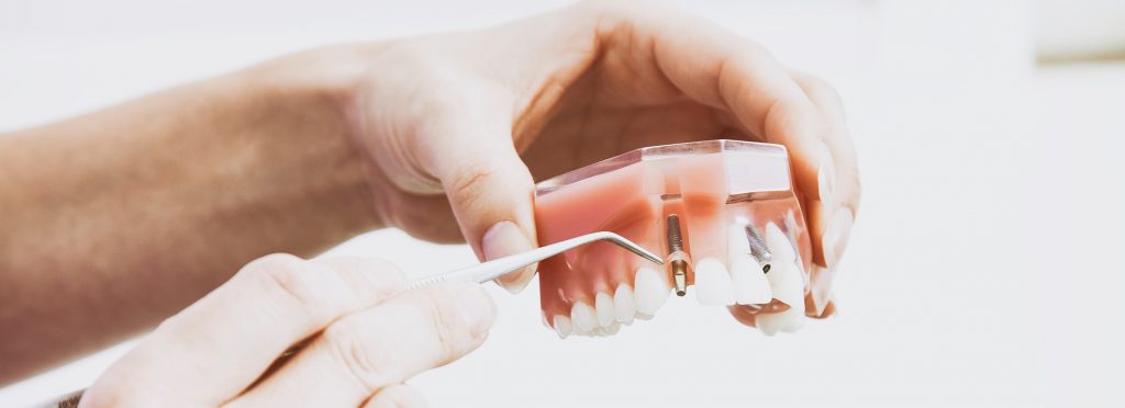 dental implants, reno cosmetic dentist
